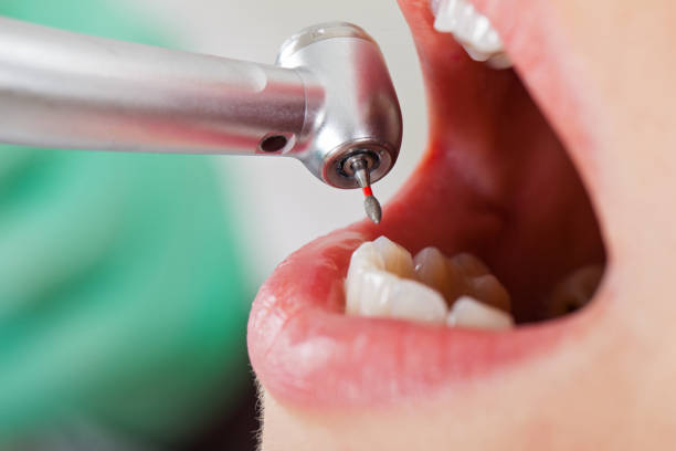Best Emergency Root Canal Treatment in Rice Lake, WI